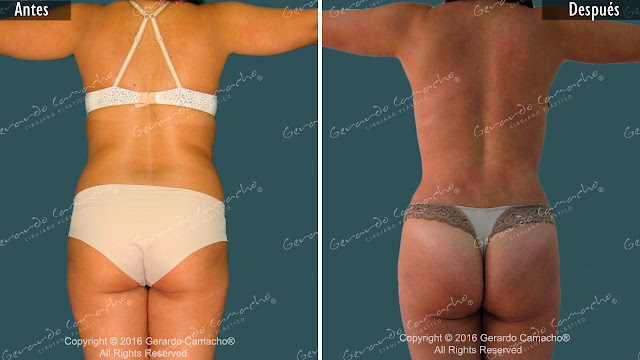 Contorno Corporal  Lipotransferencia Grasa 