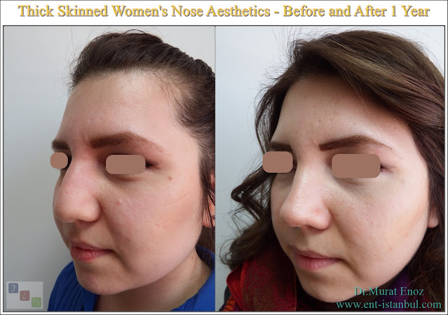 thick skinned nose job,Rhinoplasty for oily round nose,Ethnic nose aesthetic,Before and 1 year after female rhinoplasty,