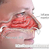 langkah mudah mengobati hidung mampet