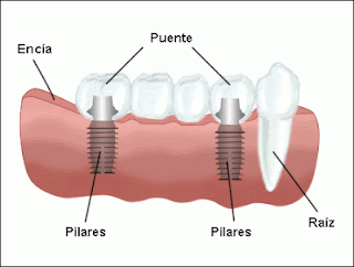 Implantes dentales múltiples