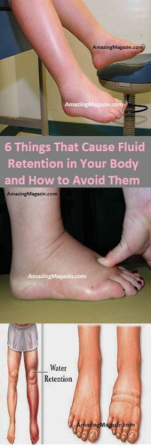 6 Things That Cause Fluid Retention in Your Body and How to Avoid Them