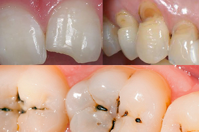 Cách khắc phục răng sâu bị sứt mẻ
