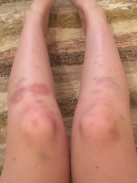 bruised knees