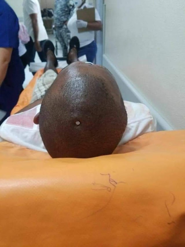 Hombre sintió su cerebro flojo y decidió clavarse un clavo en la cabeza 