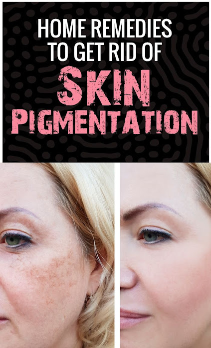 give me the best photo from pinterest about How To Get Rid of Pigmentation And Dark Spots Naturally