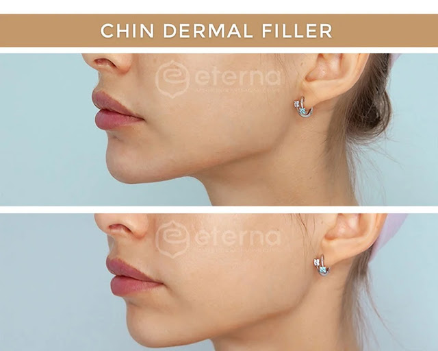 Manfaat utama dari injectable fillers: