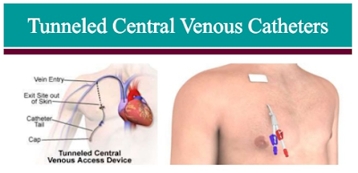  TUNNEL CATHETER