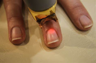 Laser Treatment for Nail Toe Fungus