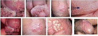 obat herpes genital