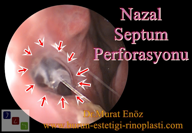 Septum perforasyonu tanımı - Septum perforasyonu  nedenleri - Septum perforasyonu belirtileri - Septum perforasyonu tedavisi - Açık teknik septum perforasyonu ameliyatı - Açık teknik septum perforasyonu onarımı - Burun duvarında delik