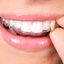 Miếng dán tẩy trắng răng - tẩy trắng răng hiệu quả và an toàn