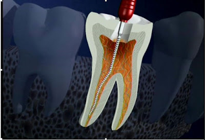 Lấy tuỷ răng xong bị sưng đau có nguy hiểm không?-1