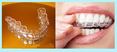 Bản chất niềng răng không mắc cài 3D Clear