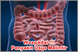 http://nugraha021212.blogspot.co.id/2017/08/penyebab-dan-cara-mengatasi-usus.html