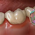 Mảng bám răng là gì và cách xử lý an toàn