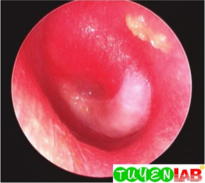  Acute otitis media, stage of suppuration