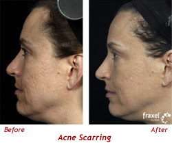 Acne scars Before And After Pictures | Acne Scar Removal