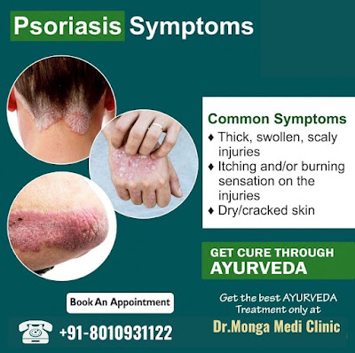 Best psoriasis treatment in South Delhi|| दक्षिणी दिल्ली में सोरायसिस उपचार||Call-8010931122||