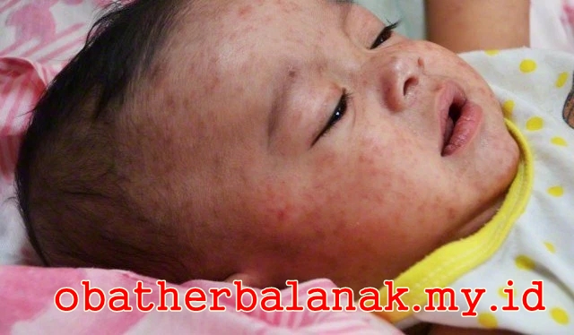 Obat Campak Pada Bayi Secara Aman dan Cepat