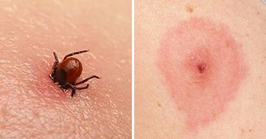 How To Recognize All 12 Most Common Bug Bites