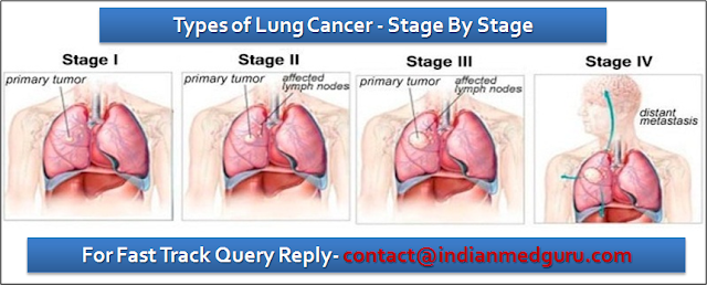 Types of Lung Cancer