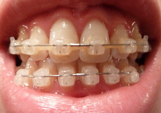 A photo of teeth with upper and lower fixed ceramic braces at 26 weeks into treatment