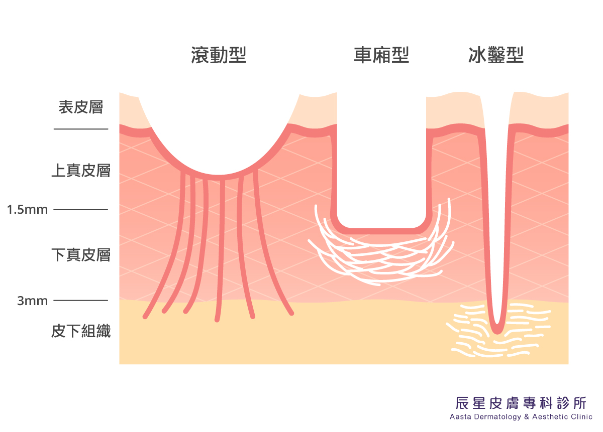 痘疤除了肌膚凹凸不平的視覺上美觀問題，還包括了在皮膚之下所形成的纖維化疤痕組織