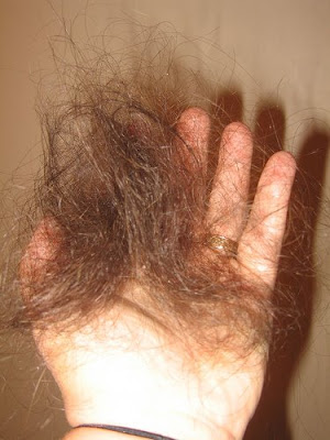 lanugo-anorexia-hair loss