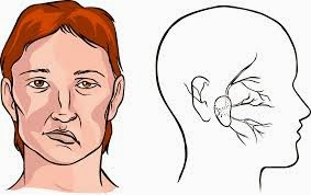  STROKE (Transient Ischemic Attack)