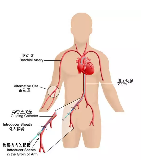 支架是這樣放進心臟的