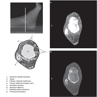 foot ankle ct scan