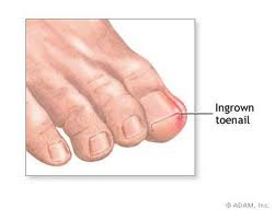 ingrown toenail