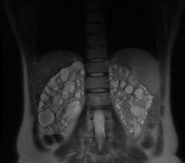 Pancreatitis-CT & MRI