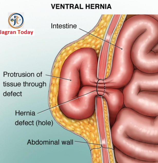 Causes and Symptoms of Hernia