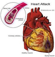 Cara Mencegah Jantung Koroner