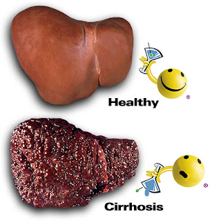 Cirrhosis of The Liver