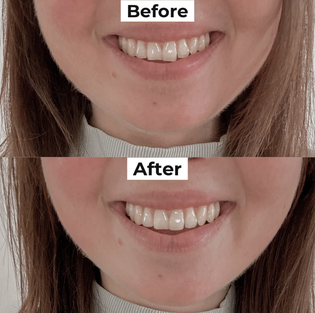 Teeth Contouring: My Experience
