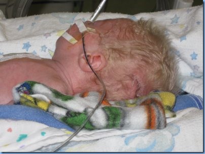 brody surgery2