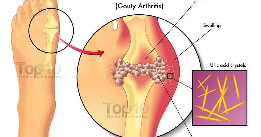 Herba Penyakit Gout: Nak penawar gout