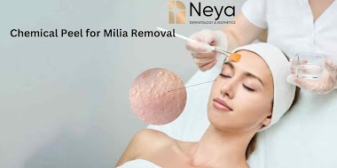 Chemical Peel for Milia Removal 