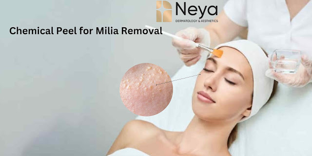 Chemical Peel for Milia Removal