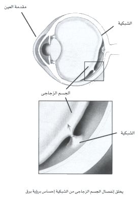 Alon In Web أمراض العيون Eye Diseases