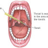 How To Know If I Have Throat Cancer : Everything You Need To Know About Throat Cancer Ent Ear Nose Throat Oladoc Com / These signs and symptoms may vary depending on the exact size and location of the tumor.