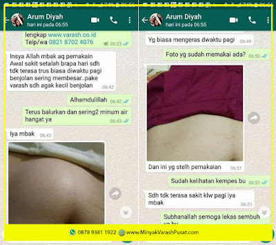 cara pakai minyak varash untuk kista