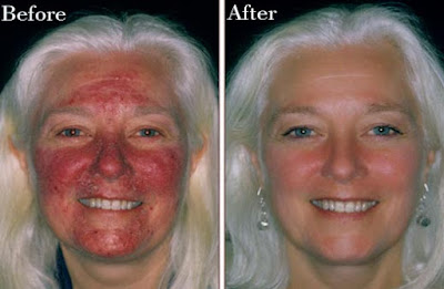 Natural Treatment For Healling Rosacea