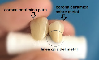 comparacion de coronas de ceramica dental