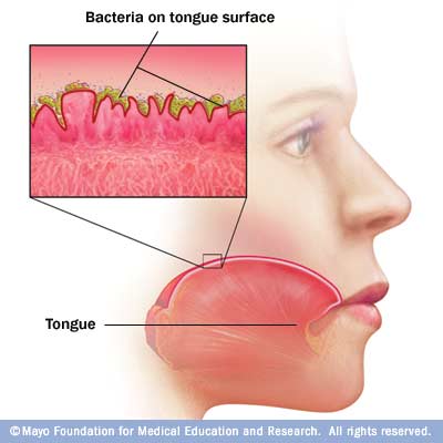 Health Tips: Mouth: halitosis-mulut berbau