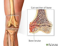 cara mengobati keropos tulang