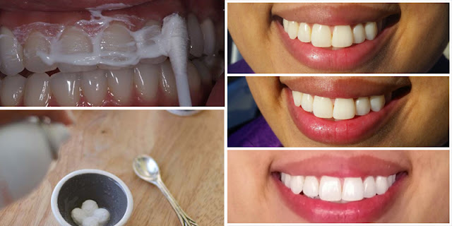 Use Aspirin And 2 Ingredients Mixture On Teeth And Make Them Whiten in 5 Minutes