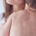 Salud Pública emite alerta epidemiológica por sarampión